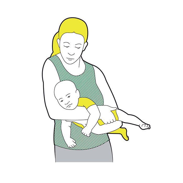 Baby minor burns and scalds - remove any jewellery or clothing