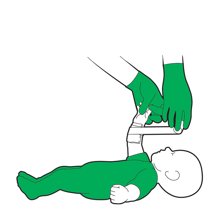 Baby severe bleed first aid - firmly secure the dressing with a bandage
